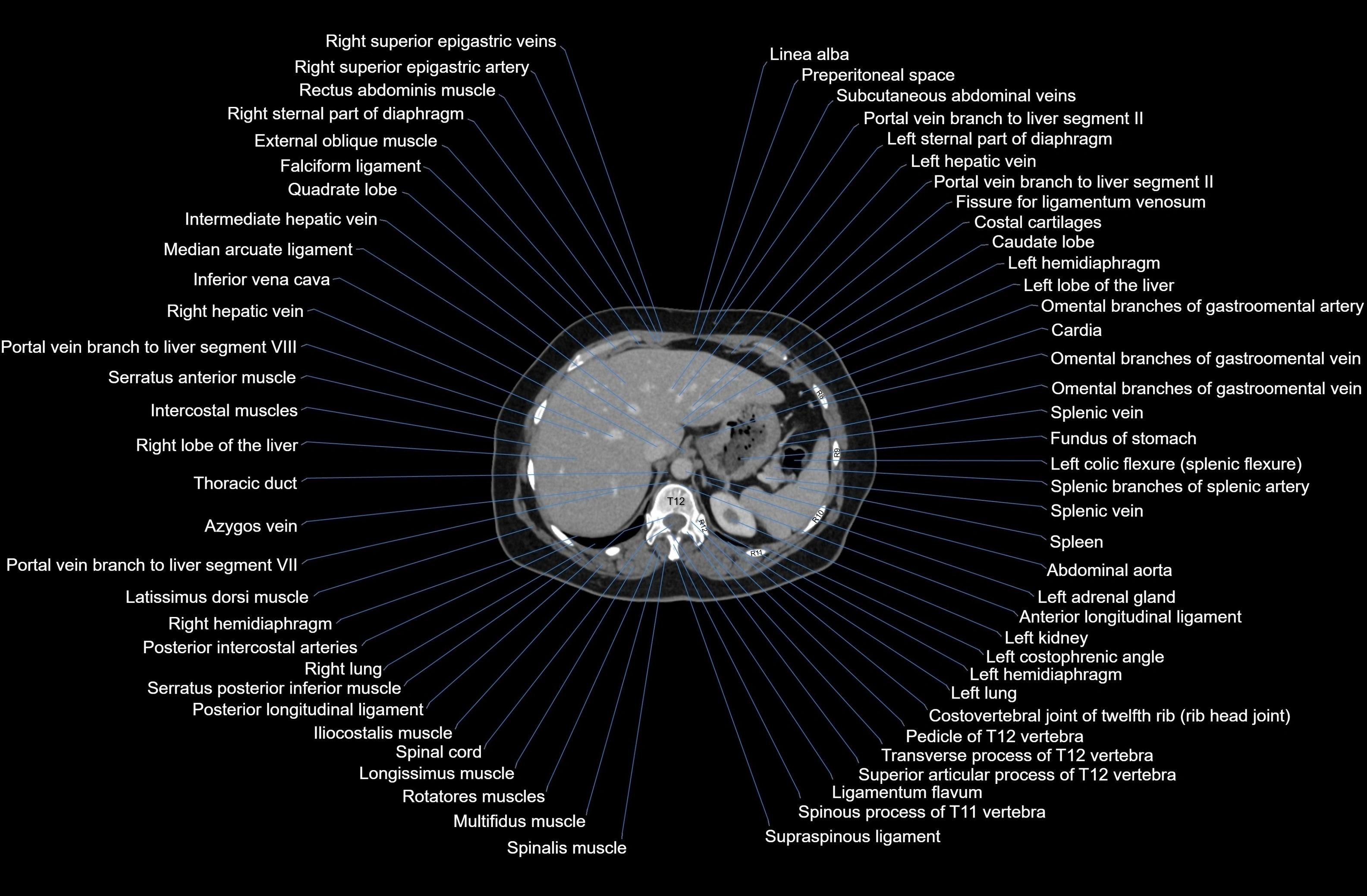 CT Abdomen axial cross sectional anatomy labelled radiology image-00017.webp